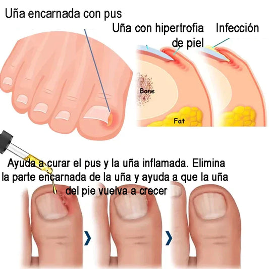 ACEITE ALEMÁN REPARADOR DE UÑAS ToenailPlus™ – FÓRMULA CONTRA HONGOS E INFECCIONES